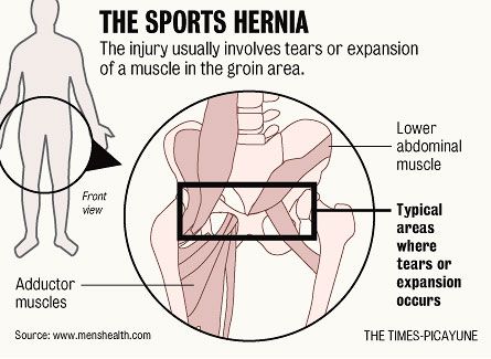 Sportsman Hernia (Athletic Pubalgia): The great mimicker of groin and